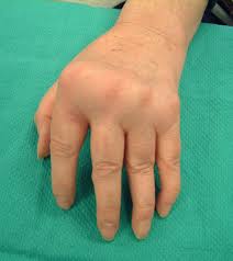 The ra latex turbid test is a diagnostic tool that looks for specific antibodies that are commonly in more severe cases, ra may cause deformities in the joints. Handrehab Wrist And Hand Deformities Kinematics Of The Wrist And Forearm