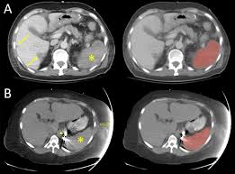Image result for CT Intravenous Contrast