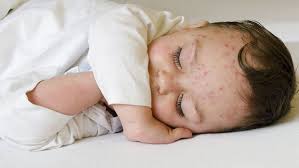 Ako znizit teplotu u deti. Pozor Na Febrilne KÅ•ce Ma Dieta Horucku Alebo Zvysenu Teplotu Hello Tesco