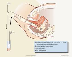 Als nidation bezeichnet man die einnistung des frühen keims (blastozyste) in die uterusschleimhaut (endometrium).sie beginnt am 6. Behandlung Ivf Icsi Behandlung Bei Unerfulltem Kinderwunsch