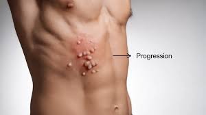 Image result for shingles