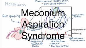 Meconium Aspiration Youtube