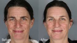 Facial Plastic Surgery