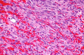 Dec 02, 2020 · kaposi's sarcoma is a type of cancer that forms in the lining of blood and lymph vessels. Treatment Of Kaposi Sarcoma Sero