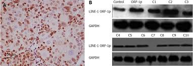 Christ army tv on eutelsat 7 west a. Long Interspersed Nuclear Element Orf 1 Protein Promotes Proliferation And Resistance To Chemotherapy In Hepatocellular Carcinoma