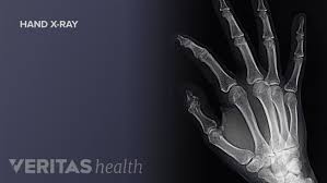 Image result for Wrist XRay