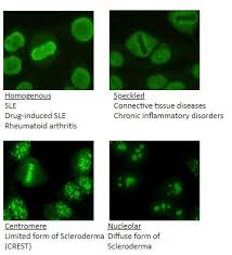 Image result for ANA Staining Pattern