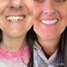 Thank you Dr. Jhon Andrade @adentart.col for enhancing my smile and  boosting my confidence by 200%! You and your team are the best. 💎✨