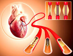Can angioplasty cure coronary artery disease? Do Angioplasty And Stents Increase Life Expectancy