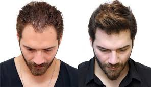 Transplante Capilar: Preço, informações e as técnicas atuais | Moda Para  Homens