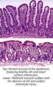 Inflammatory bowel disease (ibd) is more of a symptom than an actual disease. Feline Inflammatory Bowel Disease Nature And Treatment