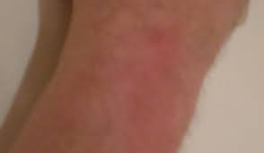 There is a small raised dark red/brown spot in the middle with a reddish i believe i was bitten by a spider last sat. Bitten By A Redback Spider In Australia Ouch But What S It Really Like