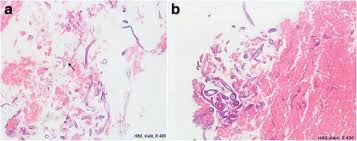 Препарат №63 «гиалиновая хрящевая ткань. Rare Complication Of Bronchoesophageal Fistula Due To Pulmonary Mucormycosis After Induction Chemotherapy For Acute Myeloid Leukemia A Case Report Journal Of Medical Case Reports Full Text