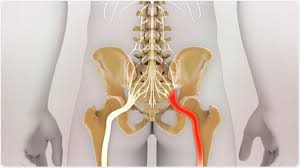 Check spelling or type a new query. Exercising With Sciatica