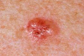 Cancer cells can spread to other parts of the body and grow there. Non Melanoma Skin Cancer Raises Malignancy Risk Gponline