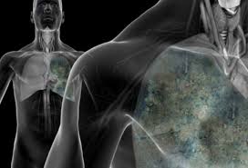 One cause of a very specific type of lung cancer called mesothelioma is triggered by asbestos. Lung Cancer Warning Signs Africa Health Organisation