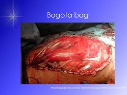 Origin of the bogota bag and its application springerlink. Abdominal Compartment Syndrome Acs Dr Emily Lai Princess Margaret Hospital Joint Hospital Surgical Grand Round 17 Apr Ppt Download