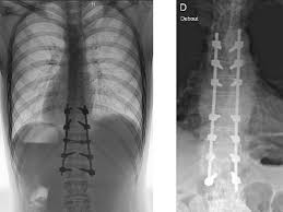 Il est vrai que ça fait peur l'idée d'une opération du dos, et que les vertebres sont. Les Pathologies De La Colonne Vertebrale Traitees A Namur