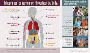 What are the signs and symptoms of larynx cancer ? Cancer And Tobacco Use Vital Signs Cdc