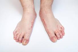 Title 5 Tips For Preventing Athlete S Foot David B Glover Dpm Facfas Podiatric Foot And Ankle Surgeon