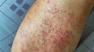 Image result for allergy rash on the legs