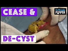 Pimple popper's youtube channel is nsfw on principle. Dr Sandra Lee