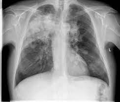 Granulomatose Mit Polyangiitis Lunge Eref Thieme