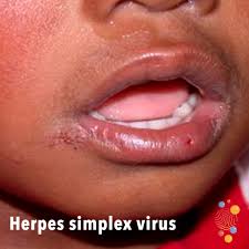 This virus is usually not an std; Herpes Simplex Virus Skin Deep