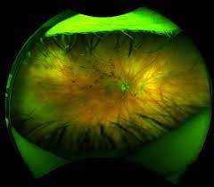 Pin By Eyedolatry On Focus On Eye Health Eye Health Natural Landmarks Veins