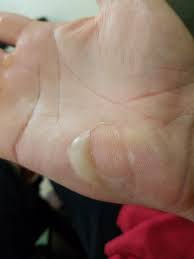 Burnt My Hand Today Album On Imgur
