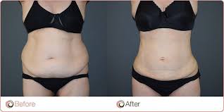 Although this is only a recommendation, it's one held closely by many plastic surgeons, and has even been translated into law in some states. How Much Fat Can Liposuction Safely Remove