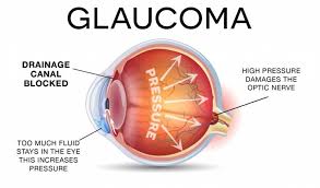 Image result for Intraocular Pressure