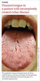 Image result for Fissured tongue
