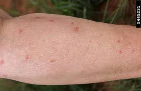 Image result for Fly Bite