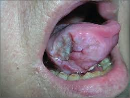 Image result for cancer of tongue