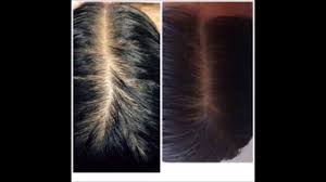 Hair loss can occur as a result of how the chemotherapy drugs work. How Much Hair Loss Is Normal For Thin Hair How To Thin Pubic Hair Growth Youtube
