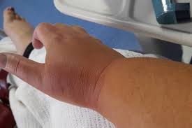 Jellyfish stings are relatively common problems for people swimming, wading or diving in seawaters. Swimmer Lucky To Be Alive After Jellyfish Sting Bbc News