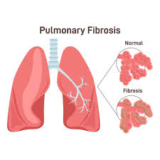 La fibrosi polmonare idiopatica (abbreviata con FPI) &egrave; una malattia  polmonare cronica progressiva caratterizzata dalla cicatrizzazione e dalla  progressiva cicatrice dei tessuti polmonari. Il termine "idiopatica"  significa che l'origine esatta &egrave; ...
