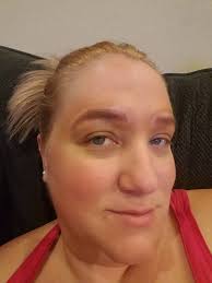 So i have been told to come for phototherapy alongwith ointment  application, how does combination treatment work? Dr. asked me to apply  ointment for two weeks, will the laser be enough later?