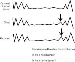 Espen lind was born on may 13, 1971 in tromsø, norway. Rules For Scoring Respiratory Events In Sleep Update Of The 2007 Aasm Manual For The Scoring Of Sleep And Associated Events Deliberations Of The Sleep Apnea Definitions Task Force Of The American