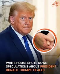 Many people were recently concerned about President Donald Trump's health  as he appeared with a big bruise