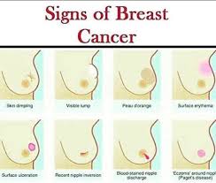 Delays in diagnosing breast cancer can cause problems. Warning Signs Of Breast Cancer In Women Women Matters