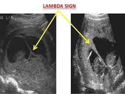 Create a lambda function alias to use as a pointer to a specific function version. What Is Lambda Sign