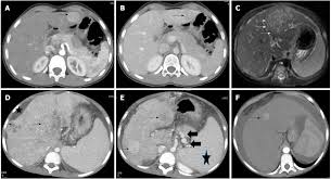 1 division of cancer epidemiology and genetics, national cancer institute, bethesda, maryland. Pediatric Hepatocellular Carcinoma