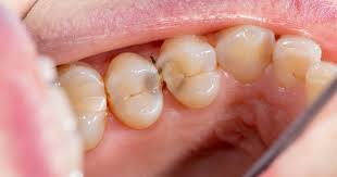 Check spelling or type a new query. What Does A Cavity Look Like Mint Hill Dentistry