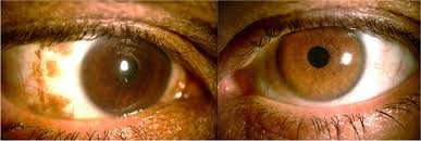 Image result for melanosis sclera