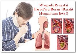 Membahas secara lengkap gejala, ciri ciri, penyebab, diagnosis klasifikasi dan cara menyembuhkan. Paru Paru Berair Boleh Menyebabkan Kematian