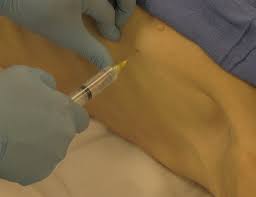Image result for Chest Tube
