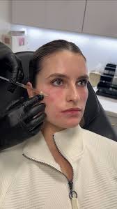 ✨Glow from within with PRF Facial Injections!✨, Rejuvenate, Restore, and  Refresh your skin naturally by harnessing the power of YOUR OWN PLATELETS!  Say goodbye to fine lines and hello to smoother, ...