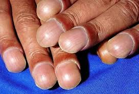 Image result for Clubbing nails feet